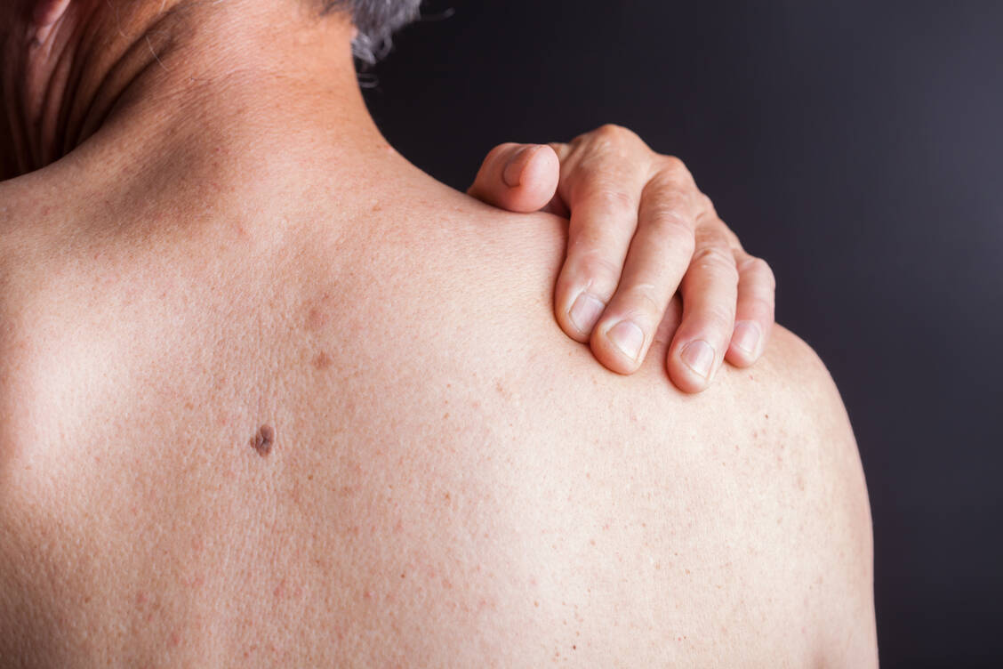Bei Parkinson-Patienten verändert sich der Geruch der Haut – vor allem am oberen Rücken. Die meisten Menschen nehmen dies aber nicht wahr. / Foto: Getty Images/jxfzsy