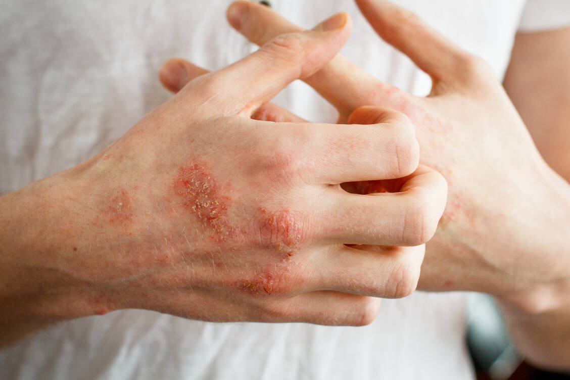 Juckreiz ist ein belastendes Symptom der atopischen Dermatitis. Mit Nemolizumab ist ein Antikörper in Erprobung, der gezielt das verursachende Interleukin 31 adressiert.  / Foto: Adobe Stock/Olga Ternavskaia