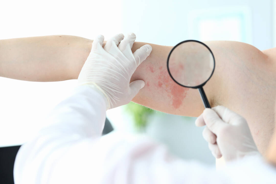 Allergiker reagieren nach einer mRNA-basierten Impfung häufige mit Nesselsucht und Angioödemen als Nicht-Allergiker. / Foto: Getty Images/Ivan-balvan