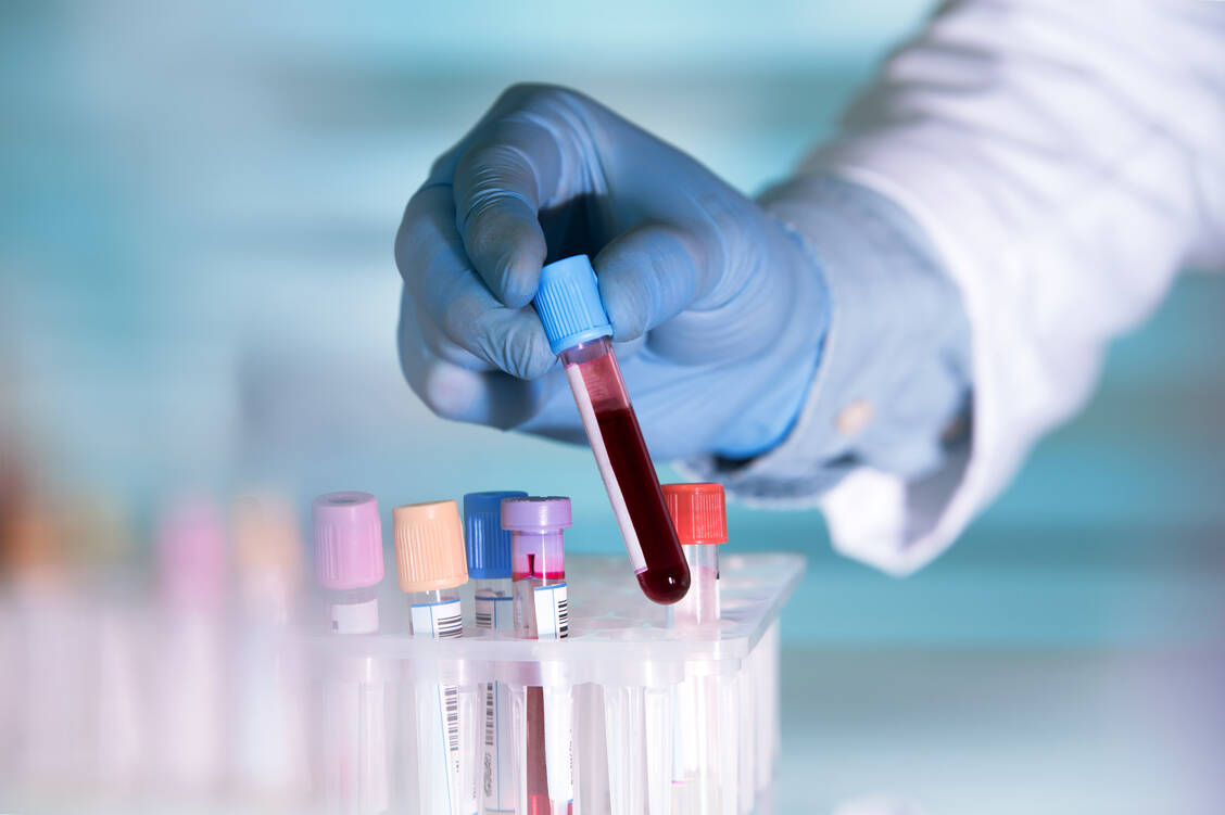 Mit der sogenannten Liquid Biopsy weist man im Blut zirkulierende freie Tumor-DNA nach. Das Verfahren eignet sich jedoch nur bei hoher Sensitivität und Spezifität zur Krebsfrüherkennung. / Foto: Shutterstock/angellodeco