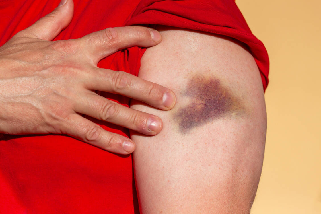 Verursachen zum Beispiel harmlose Verletzungen einen Bluterguss, kann dies ein erstes Anzeichen für einen Thrombozytenmangel sein.  / Foto: Adobe Stock/Martin Sandera 2017