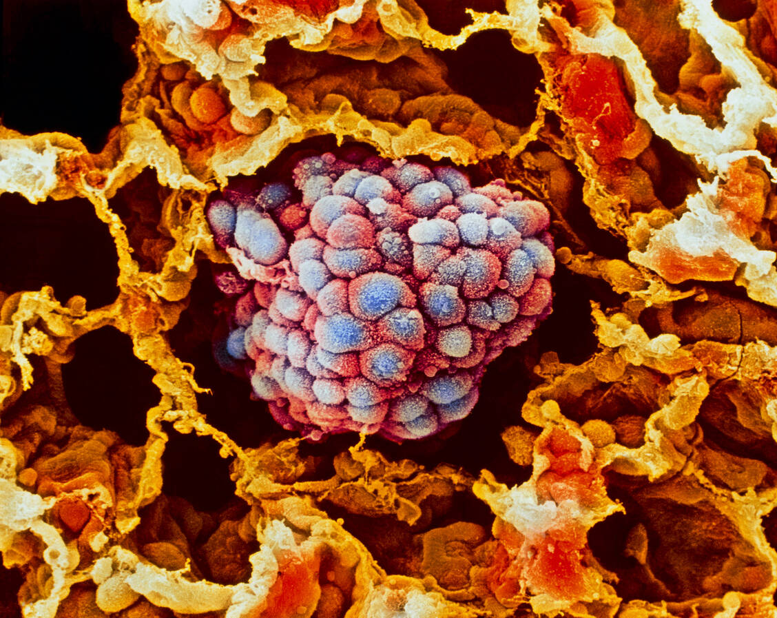 Nicht kleinzelliger Lungenkrebs (NSCLC) macht etwa 80 Prozent der Lungenkrebsfälle aus. Die jährliche Neuerkrankungsrate in Deutschland beträgt etwa 40.400. / Foto: Getty Images/Science Photo Library/Moredun Animal Health Ltd