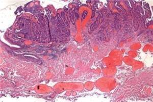 Rektumkarzinom  in der  Histologie
<p class="fotonachweis">Foto:  Felix-Burda-Stiftung</p>