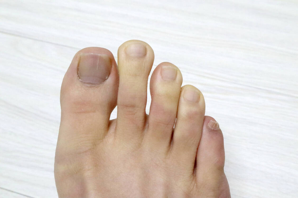 Beim Raynaud-Syndrom reagieren die Blutgefäße von Fingern und Zehen mit starker Kon­striktion und Spasmen. / Foto: Adobe Stock/younghun