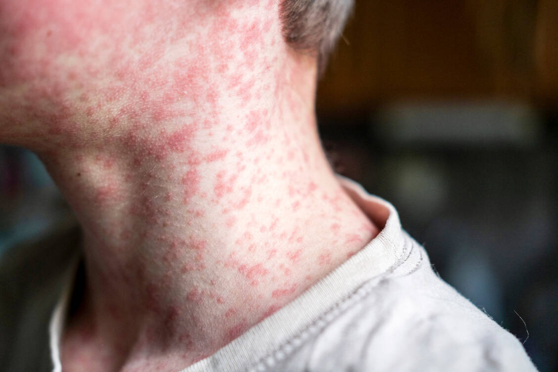 Das Masernvirus löst bei fast allen ungeschützten Menschen Symptome aus. Typisch sind Fieber, Husten und dieser Hautausschlag. / © Getty Images/Natalya Maisheva