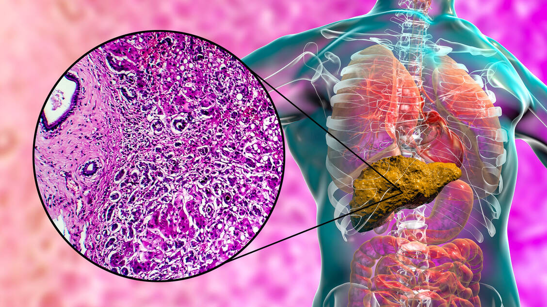 Die primäre biliäre Cholangitis ist eine autoimmun vermittelte Lebererkrankung, bei der es zu entzündlichen Veränderungen der intrahepatischen Gallenwege und in der Folge zur Cholestase kommt. Die Erkrankung verläuft sehr unterschiedlich: von symptomlos über Leberfibrose und -zirrhose bis hin zum Transplantationsbedarf und Tod. / Foto: Adobe Stock/ Dr_Microbe