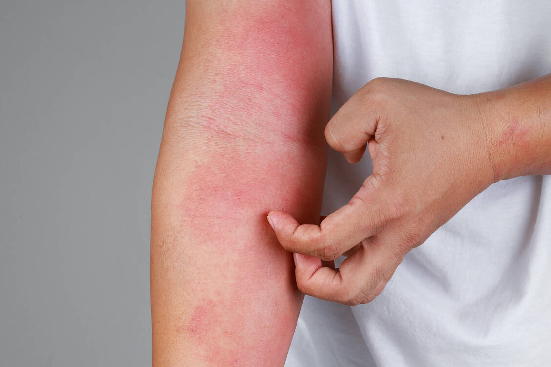 In Europa wird die Prävalenz  der atopischen Dermatitis bei Erwachsenen auf 4,4 bis 7,1 Prozent geschätzt. Zu den Anzeichen und Symptomen gehören unter anderem gereizte und stark juckende Haut sowie gerötete Hautläsionen, die nässen und verkrusten können. / © Getty Images/tylim