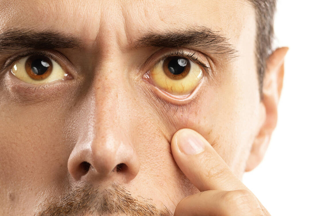 Erschöpfung, Unwohlsein, Gelenkschmerzen und leichtes Fieber: Die Beschwerden einer akuten Hepatitis B sind unspezifisch. Nur ein Teil der Patienten entwickelt typische Zeichen einer Gelbsucht (Ikterus). / Foto: Adobe Stock/blackday