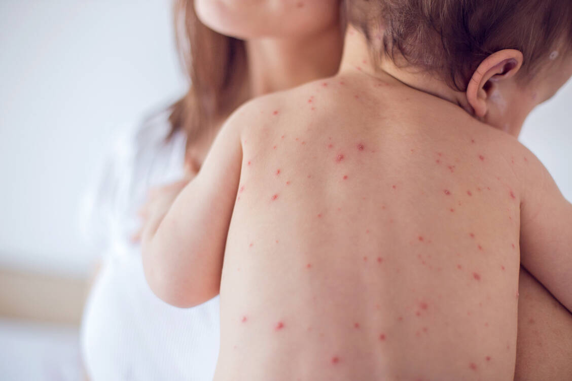 Im vergangenen Jahr stieg die Zahl der Masernerkrankungen drastisch an. Etwa 136.000 Menschen starben an der Infektionskrankheit. / Foto: iStock/South_agency