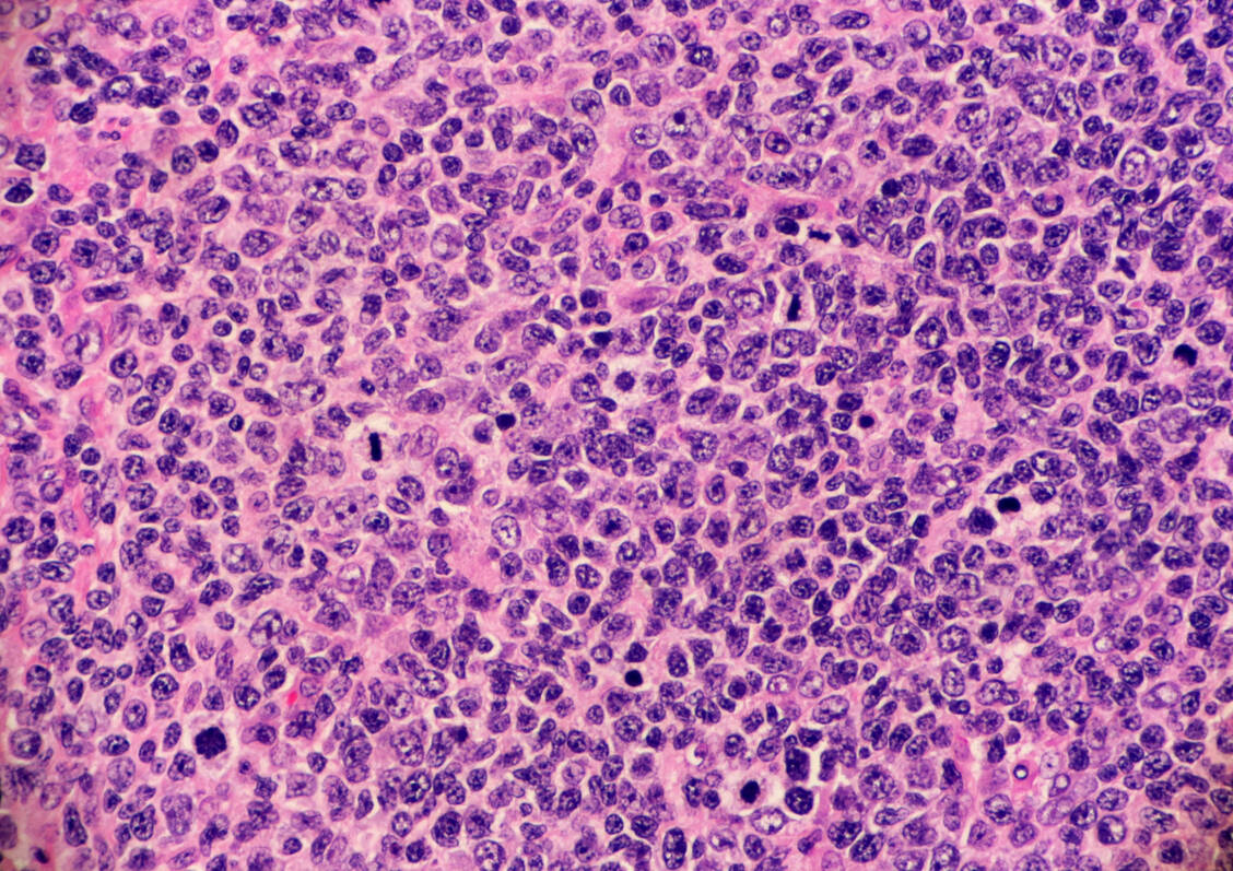 Neue Therapieoptionen bei Lymphomerkrankungen werden weltweit gebraucht, Mosunetuzumab hat nun eine EU-Zulassungsempfehlung ab der Drittlinie beim follikulären Lymphom erhalten. / Foto: Adobe Stock/Lisa