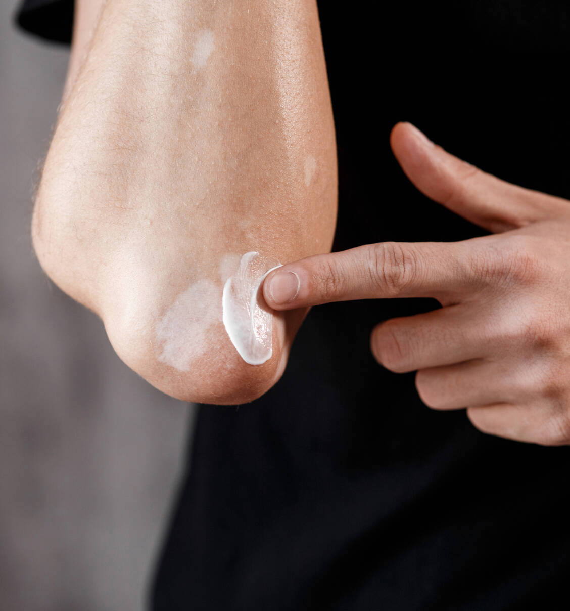 Sind weniger als 3 Prozent der Körperoberfläche betroffen, stellen topische Corticoide die Therapie der Wahl dar. / Foto: Adobe Stock/Ilnur