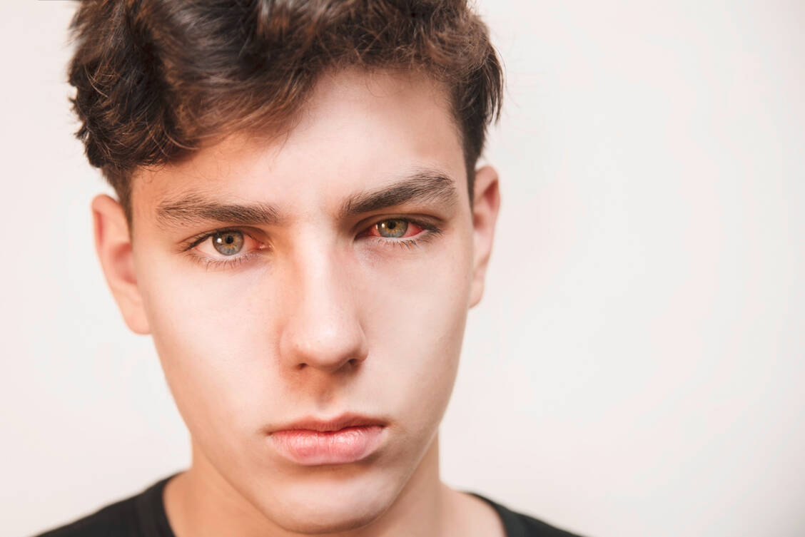 Rote Augen können auf eine Coronainfektion hindeuten: In Studien war eine Bindehautentzündung (Konjunktivitis) ein häufiges Symptom einer SARS-CoV-2-Infektion am Auge. / Foto: Adobe Stock/Marian Fil