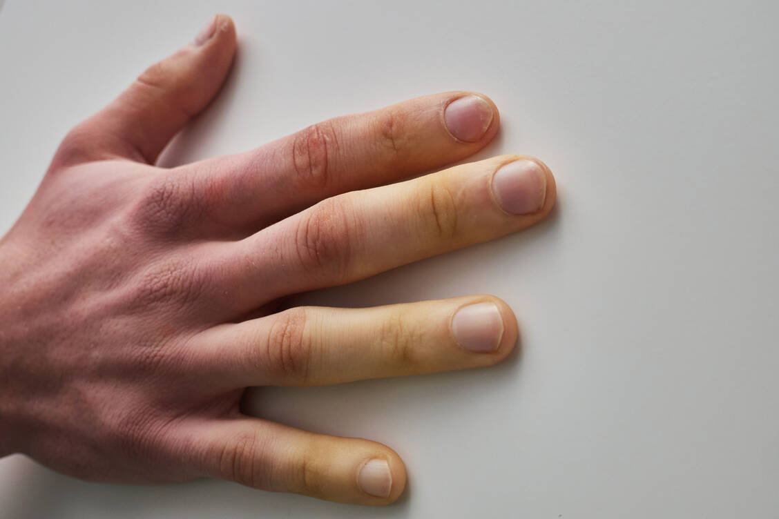 Bei Patienten mit Raynaud-Syndrom erblassen die Finger bei Stress oder bei Kälte.  / Foto: Adobe Stock/Mykhailo