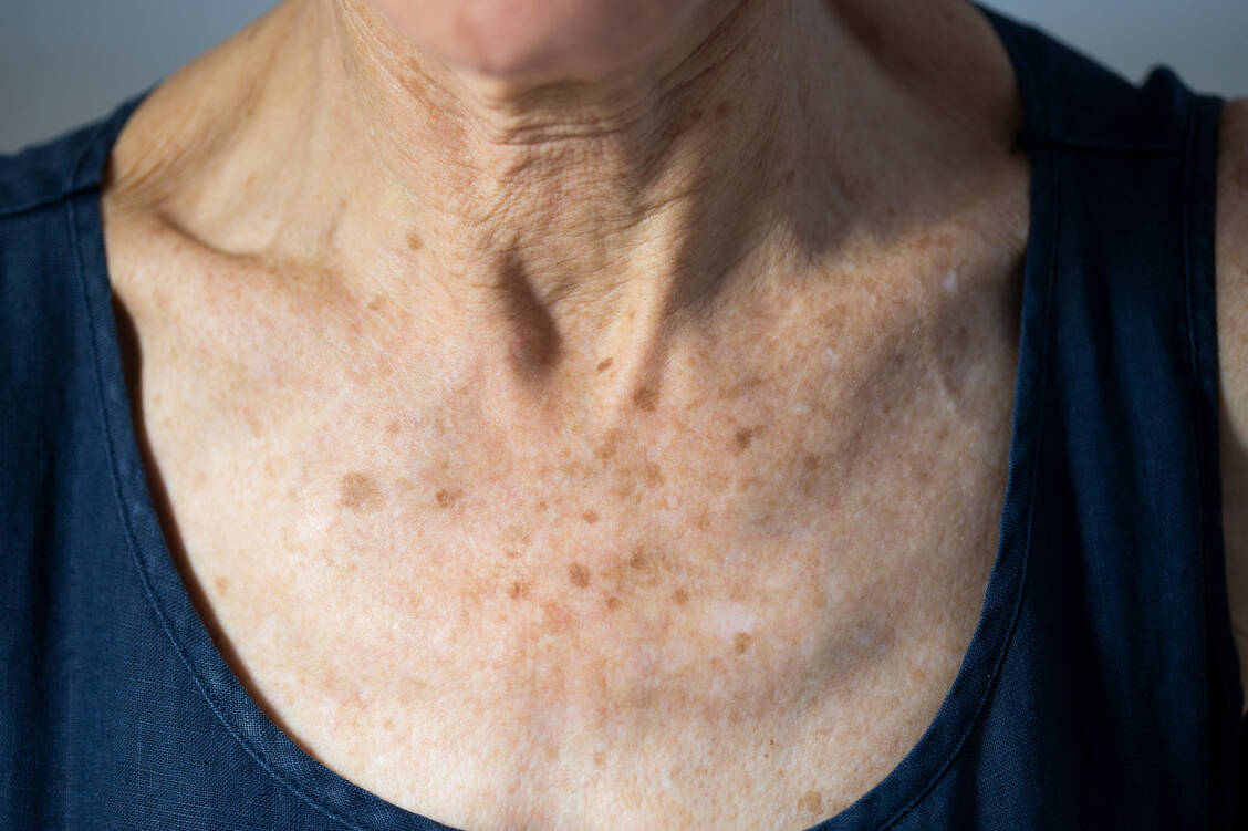 An sonnenexponierten Körperstellen wie Gesicht, Dekolleté oder Handrücken können Altersflecken auftreten. / Foto: Getty Images/BSIP/UIG