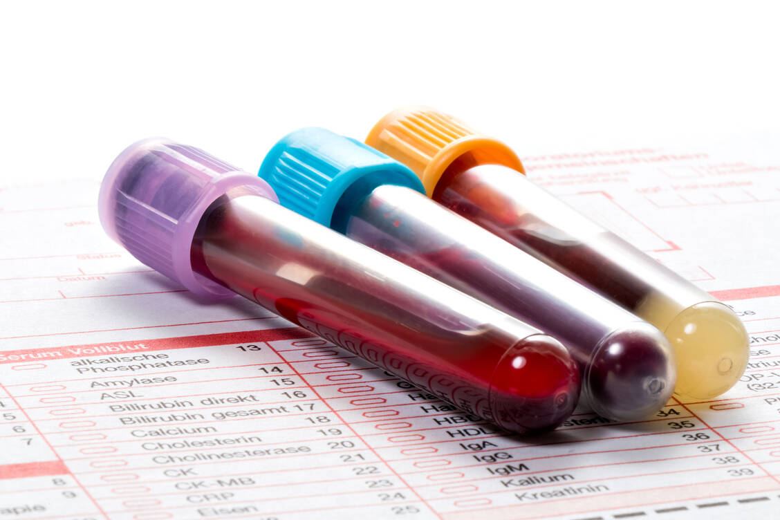 Zur Bestimmung des Eisenstatus werden aus dem Blut neben dem Hämoglobinwert auch weitere Parameter wie das Serum-Ferritin gemessen. / Foto: Adobe Stock/Henrik Dolle
