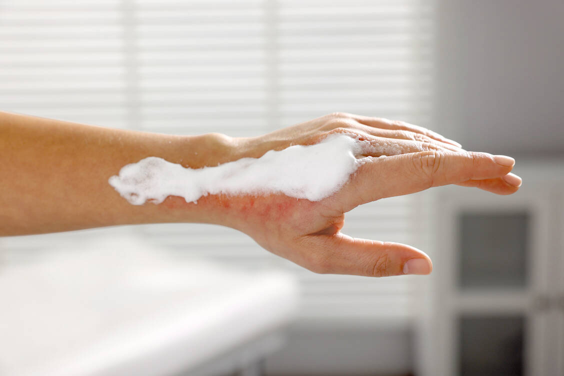 Sehr hilfreich bei oberflächlichen Verletzungen und Brandwunden ist topisches Dexpanthenol. / © Adobe Stock/New Africa