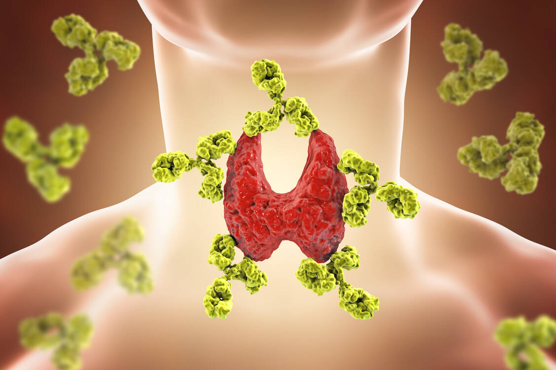 Zu den häufigsten Autoimmunerkrankungen gehört die Hashimoto-Thyreoiditis, bei der körpereigene Immunzellen die Schilddrüse angreifen (Symbolbild). / Foto: Adobe Stock/Kateryna_Kon
