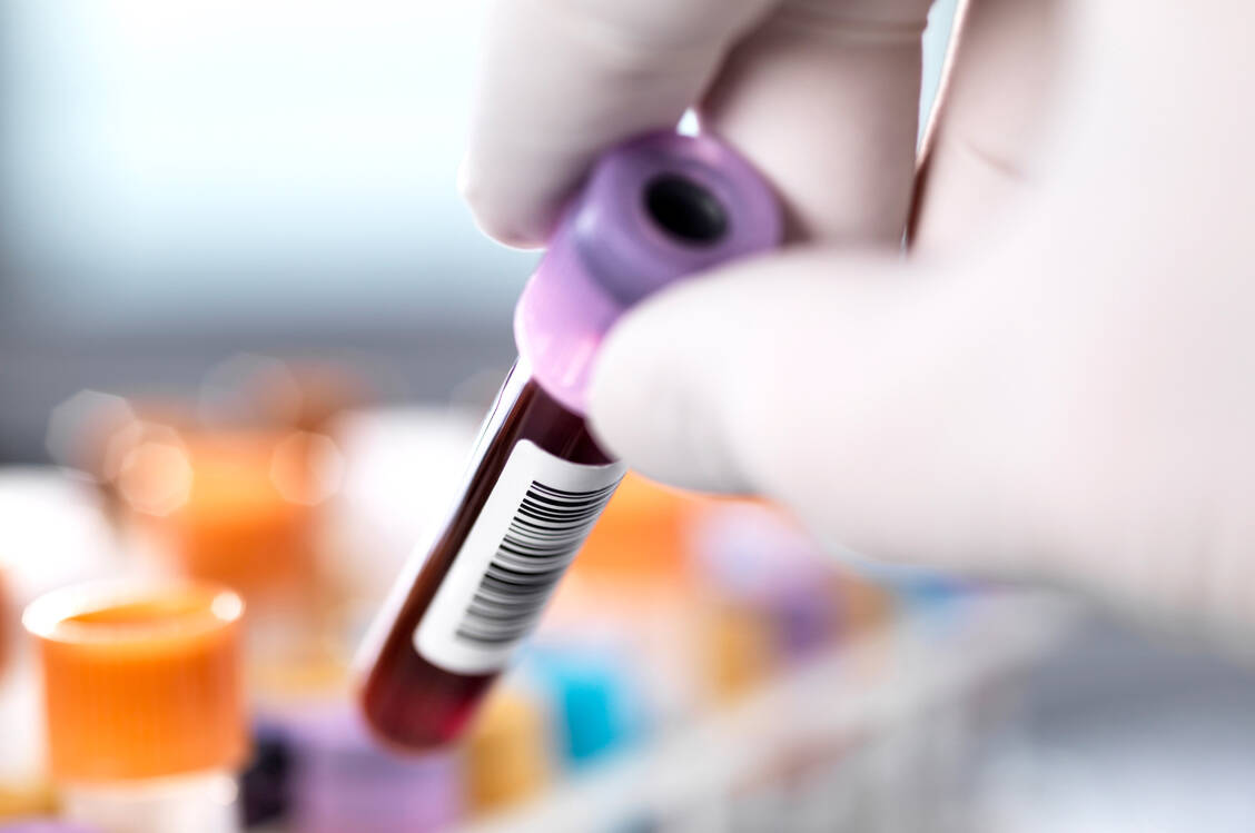 Ein Teil der zielgerichteten Therapien setzt voraus, dass spezifische Biomarker im Blut oder Liquor nachgewiesen wurden. / © Getty Images/Tek Image/Science Photo Library