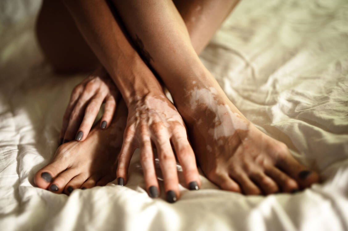 Bei der Vitiligo kann die Depigmentierung lokal begrenzt oder sehr großflächig sein. Auffällig ist sie in jedem Fall. / Foto: Getty Images/Natalie Zotova