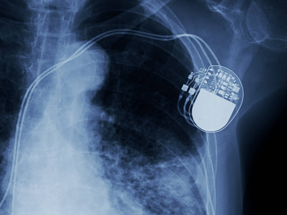 Auf die Hersteller von Medizinprodukten wie zum Beispiel Herzschrittmachern kommen bald strengere Vorgaben zu als bisher. / Foto: Fotolia/Choo