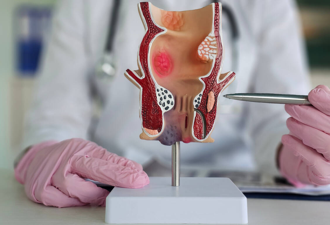 Das Plattenepithelkarzinom des Analkanals macht etwa 85 Prozent aller Analkrebserkrankungen aus. Retifanlimab steht kurz davor, als erste PD1-gerichtete Krebsimmuntherapie in der EU bei diesem Karzinom zugelassen zu werden. / © Adobe Stock/Nadzeya