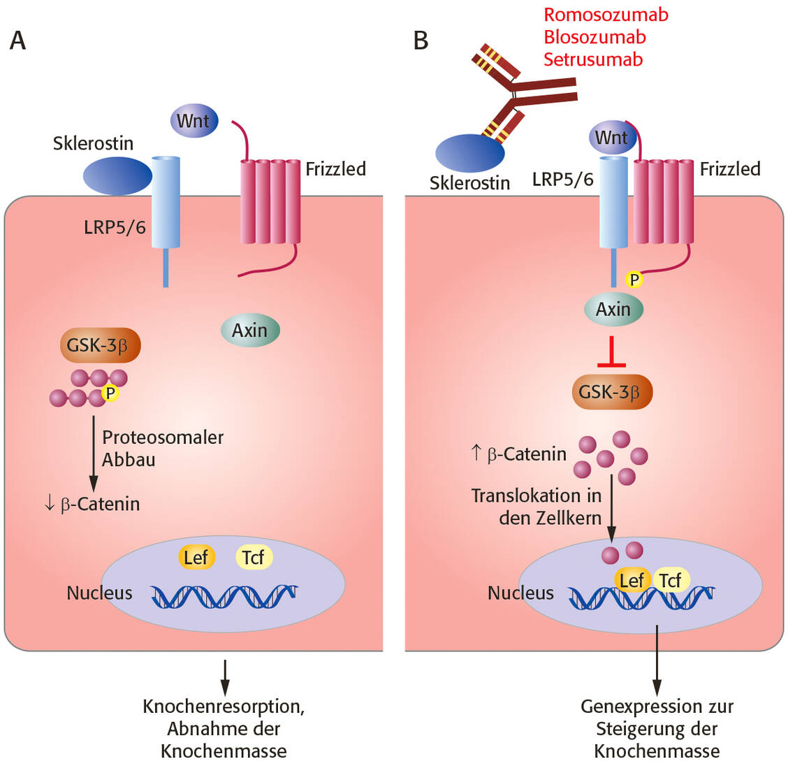 Einfluss von Sklerostin auf die Wnt/β-Catenin-Signaltransduktion in der Osteogenese. A) Sklerostin bindet an den LRP5/6-Rezeptor, verhindert damit, dass Wnt binden kann und sich der Frizzled-LRP-Komplex bildet. Infolgedessen wird über die Glykogensynthase-Kinase 3β (GSK-3β) β-Catenin phosphoryliert und steht damit durch proteosomalen Abbau nicht mehr als Transkriptionsfaktor im Kern zur Verfügung. Die Osteoblastenfunktion wird dadurch unterbunden und die Knochenresorption überwiegt. B) Bindet ein Antikörper an Sklerostin, wird die Interaktion mit LRP5/6 verhindert, Wnt bindet an den Frizzled-LRP-Komplex und infolgedessen wird GSK-3β inhibiert. Die Konzentration von β-Catenin steigt und das Protein kann in den Zellkern translozieren, wo es die Genexpression so beeinflusst, dass es zum Knochenaufbau kommt. / Foto: Avoxa