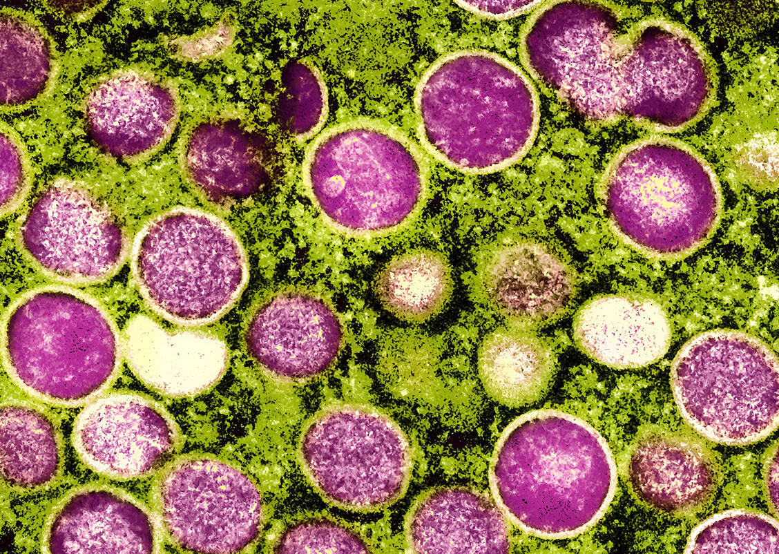 Vom Mpox-Virus gibt es zwei Typen: Klade I und Klade II. Letztere gilt als weniger virulent und gefährlich als Klade I. / © Imago Images/BSIP