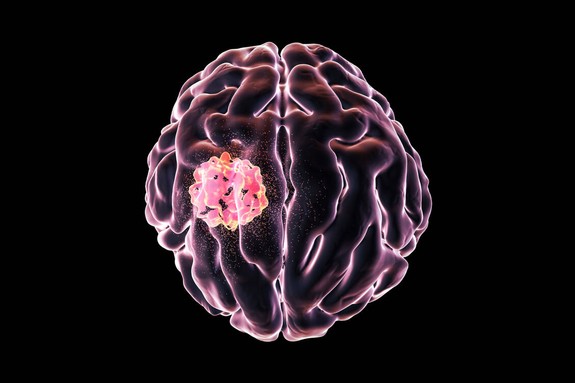 Pädiatrische hochgradige Gliome haben eine schlechte Prognose. Nun haben Forschende einen neuen möglichen Therapieansatz entdeckt. / © Getty Images/Kateryna Kon/Science Photo Library