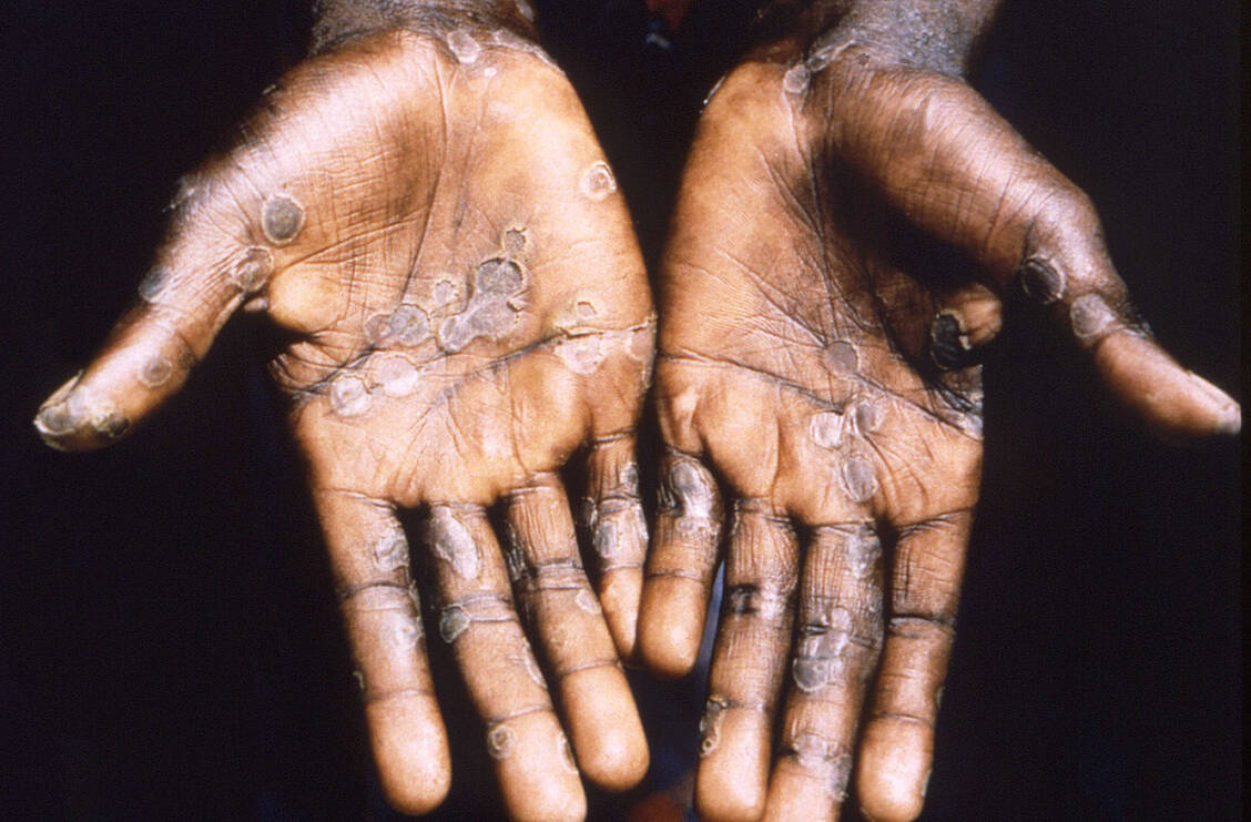 Affenpocken haben ein ähnliches klinisches Bild wie Pocken, sie verlaufen aber in der Regel milder.  / Foto: CDC/Yvan J.F. Hutin et al