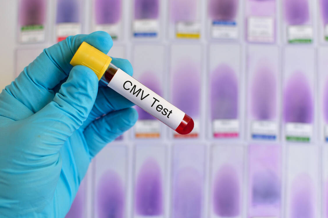 Die Zytomegalie ist eine Infektionserkrankung, die beim Menschen durch das humane Zytomegalievirus (HCMV) verursacht wird.  / Foto: Adobe Stock/jarun011