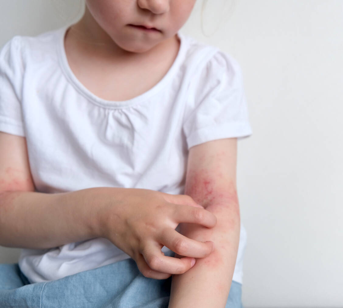 Die Prävalenz für atopische Dermatitis ist im Kindes- und Jugendalter höher als im Erwachsenenalter. Ab einem Alter von zwei Jahren darf bei mittelschwerer bis schwerer atopischer Dermatitis nun der JAK-Hemmer Baricitinib zum Einsatz kommen. / Foto: Adobe Stock/Marina Terechowa