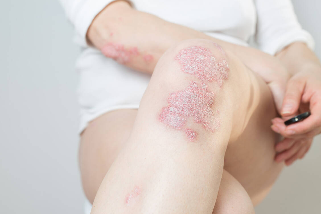 Rötlich-weiße Plaques auf der Haut sind das bekannteste Erscheinungsbild der Psoriasis. / © Adobe Stock/SNAB