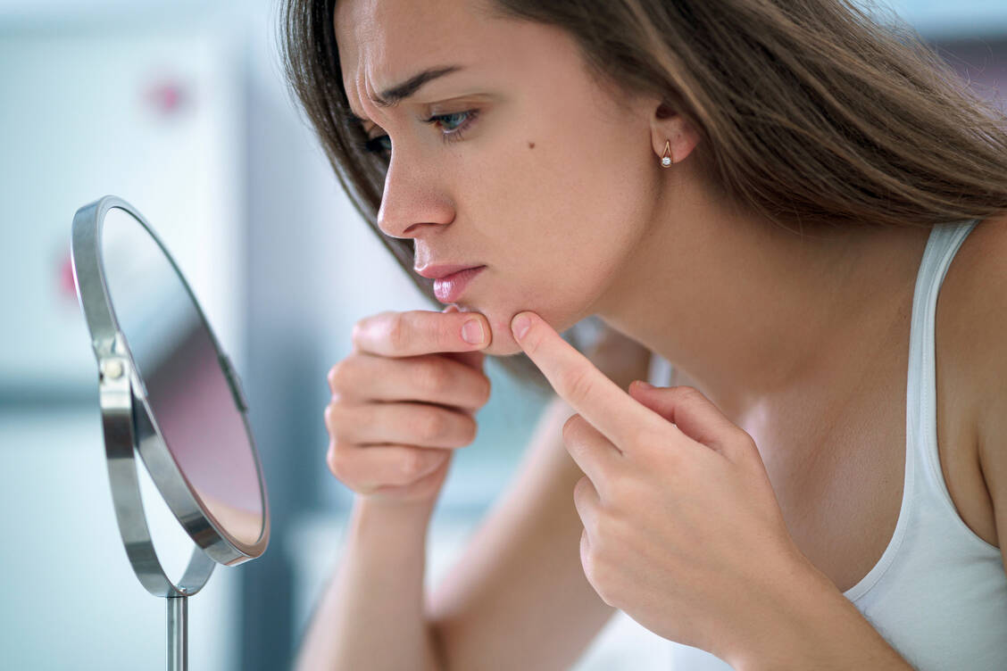 Bei jüngeren Frauen ist das Phänomen der Acne excoriée des jeunes filles zu beobachten, das durch zwanghafte Manipulation im Gesicht und zurückbleibende Erosionen und Narben entsteht. / Foto: Adobe Stock/Goffkein