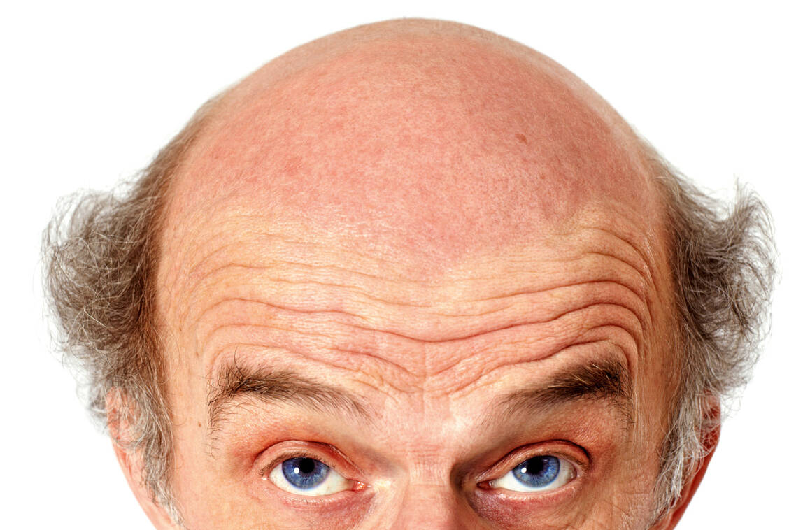 Glatze als »Sonnenterasse«: Hier bilden sich bevorzugt aktinische Keratosen.  Diese sollten immer behandelt werden, da sie maligne proliferieren können. / Foto: Fotolia/Ingo Bartussek