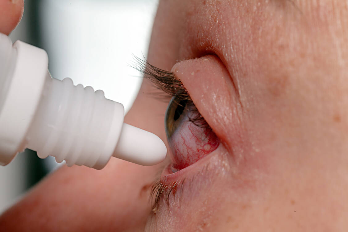 Die Symptome einer okulären Rosacea ähneln denen einer Konjunktivitis, Keratitis oder Blepharitis und müssen nach eindeutiger Diagnose entsprechend therapiert werden. / Foto: Adobe Stock/Cpro