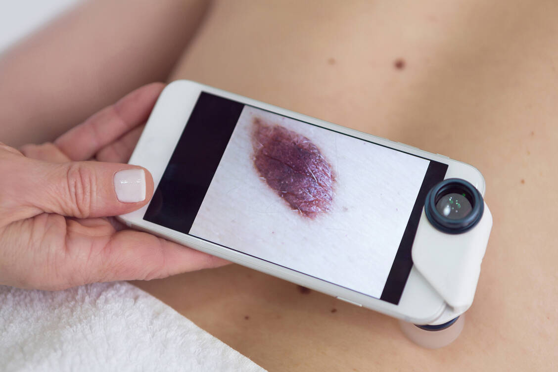 Die Bewertung von digitalen Aufnahmen von Muttermalen zur Hautkrebsdiagnose war eine der ersten Aufgaben, für die medizinische KI-Systeme entwickelt wurden. / Foto: Paz Ruiz Luque