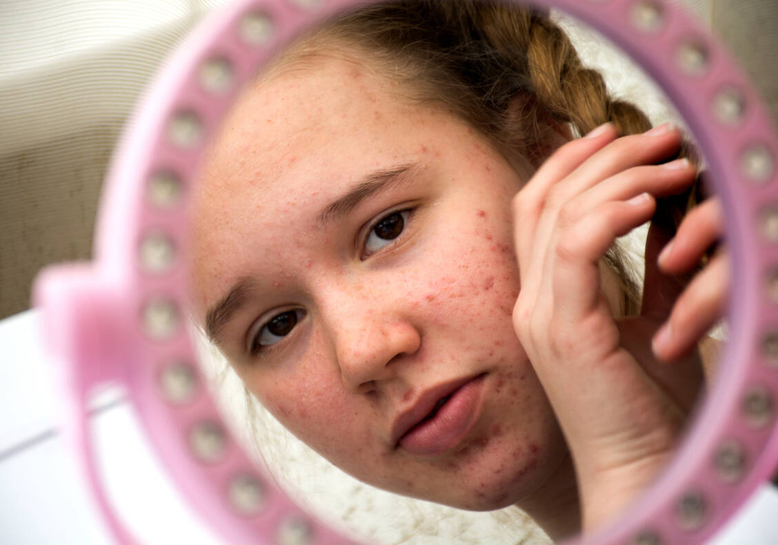 Akne trifft Jugendliche in einem Alter, in dem sie meistens sehr auf ihr Äußeres bedacht sind. Das kann erheblichen Leidensdruck verursachen. / © Getty Images/Irina Boriskina