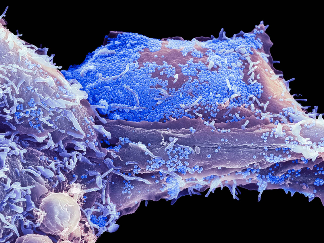 Infektionen mit dem Herpes-simplex-Virus (HSV) 1 werden als möglicher Auslöser der Alzheimer-Demenz diskutiert. / Foto: Science Photo Library