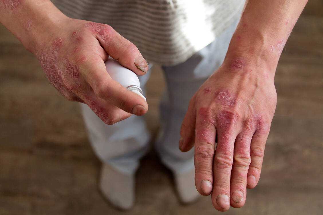 Entzündliche Dermatosen gehen meist mit einem hohen Leidensdruck einher. Es dauert oft lang, bevor Patienten einen Facharzttermin bekommen. / © Getty Images/Irina Gulyayeva