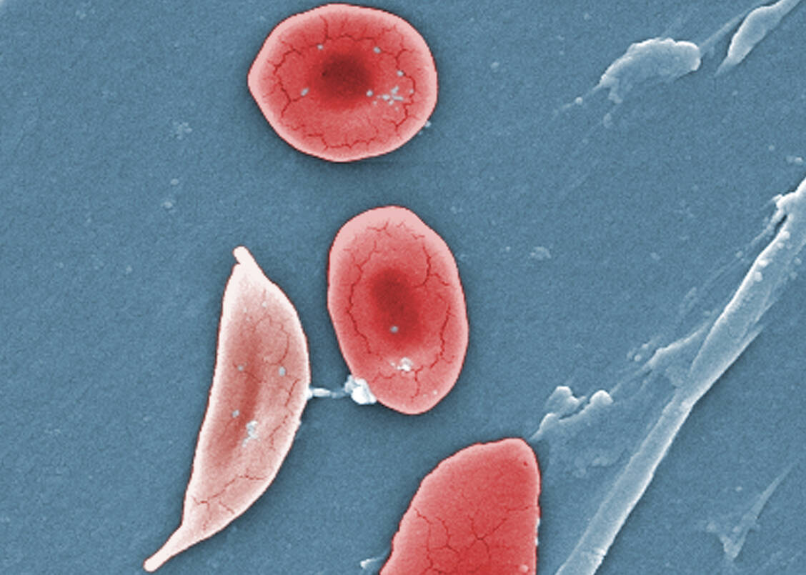 Bei Patienten mit der Erbkrankheit Sichelzellanämie nehmen die roten Blutkörperchen bei Sauerstoffmangel eine charakteristische Form an, die an eine Sichel erinnert. Sie können miteinander verklumpen und kleine Blutgefäße verstopfen. / Foto: CDC
