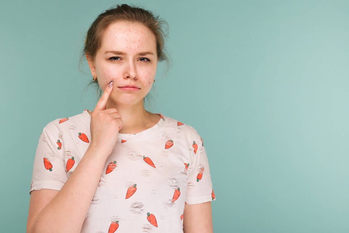 Eine schwere Akne kann mit Retinoiden behandelt werden. Frauen im gebärfähigen Alter müssen dann unbedingt zuverlässig verhüten, denn schätzungsweise 4 von 10 Schwangerschaften entstehen ungeplant. Dann ist der Embryo durch die Retinoid-Therapie in Gefahr. / Foto: Adobe Stock/filins