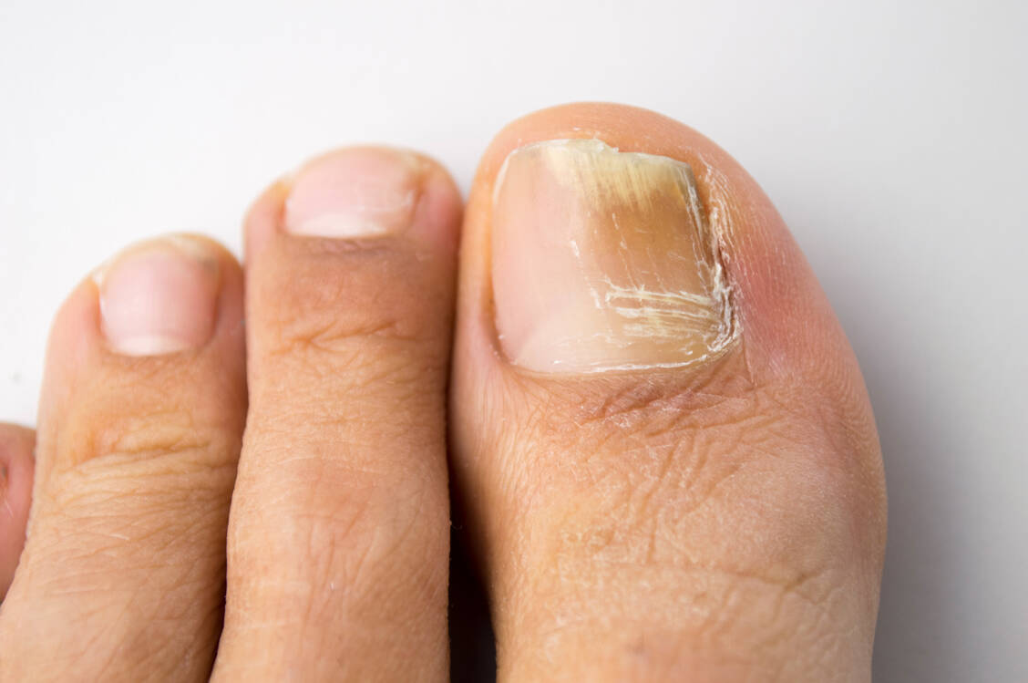 Eine weitere Therapieoption zur Behandlung von Nagelpilz ist auf den deutschen Markt gekommen: das Azol-Antimykotikum Efinaconazol. / © GettyImages/Manuel-F-O