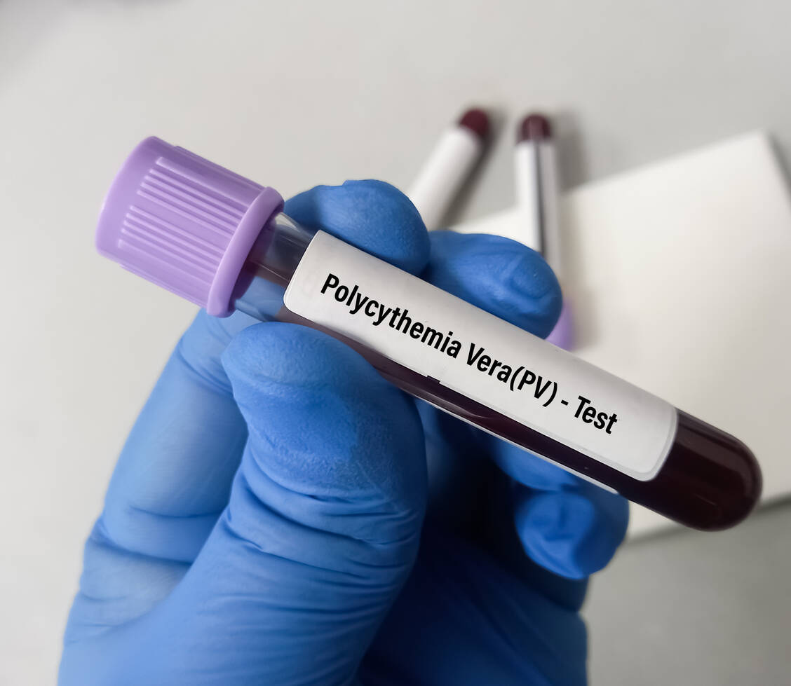 Eine Myelofibrose kann auch infolge einer Polycythaemia vera, einer myeloproliferativen Erkrankung, entstehen. / Foto: Adobe Stock/MdBabul