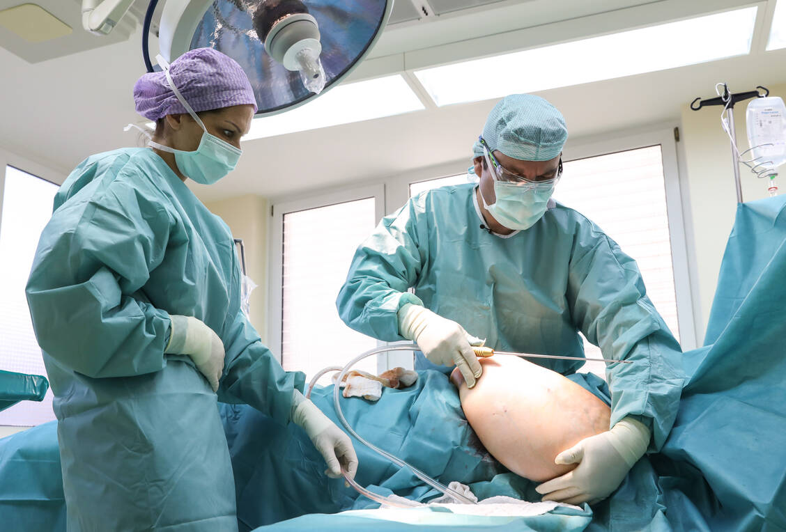 Bei der Liposuktion wird das krankhaft vermehrte Fettgewebe operativ entfernt. / Foto: Imago Images/Tobias Wölki
