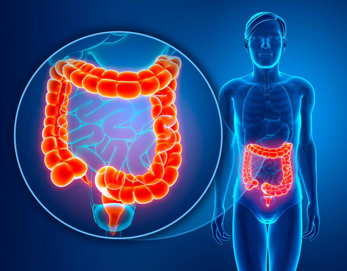 Rechts- und linksseitiger Darmkrebs ist häufig verschieden. Als rechtsseitig gilt eine Lokalisation im Caecum bis einschließlich Colon transversum, als linksseitig der absteigende Teil des Kolons und das Rektum. / Foto: Adobe Stock/pixdesign123