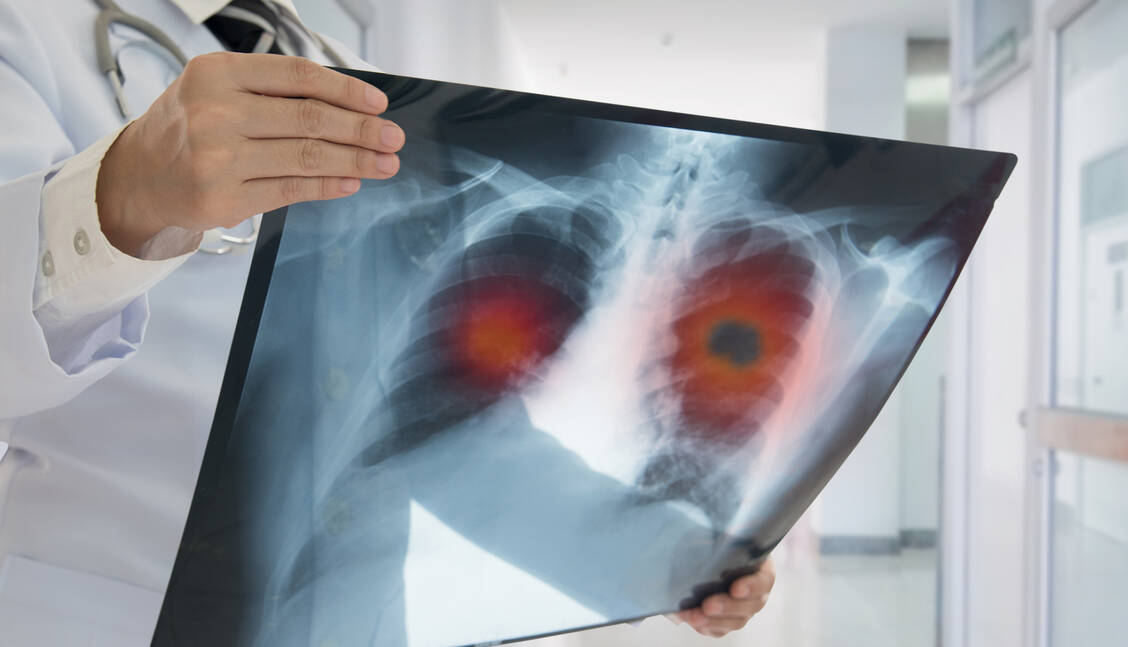 Lungenkrebs ist die häufigste krebsbedingte Todesursache in Deutschland. Für Patienten mit nicht kleinzelligem Lungenkrebs gibt es mit Tremelimumab eine neue Therapieoption.  / Foto: Adobe Stock/ utah51