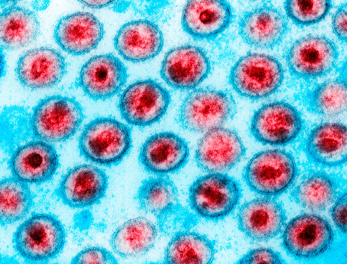 Ist im Blut eines ehemals mit HIV infizierten Menschen trotz Absetzen der Medikamente kein Virus mehr nachweisbar, spricht man von einer Remission. / Foto: Getty Images/Callista Images