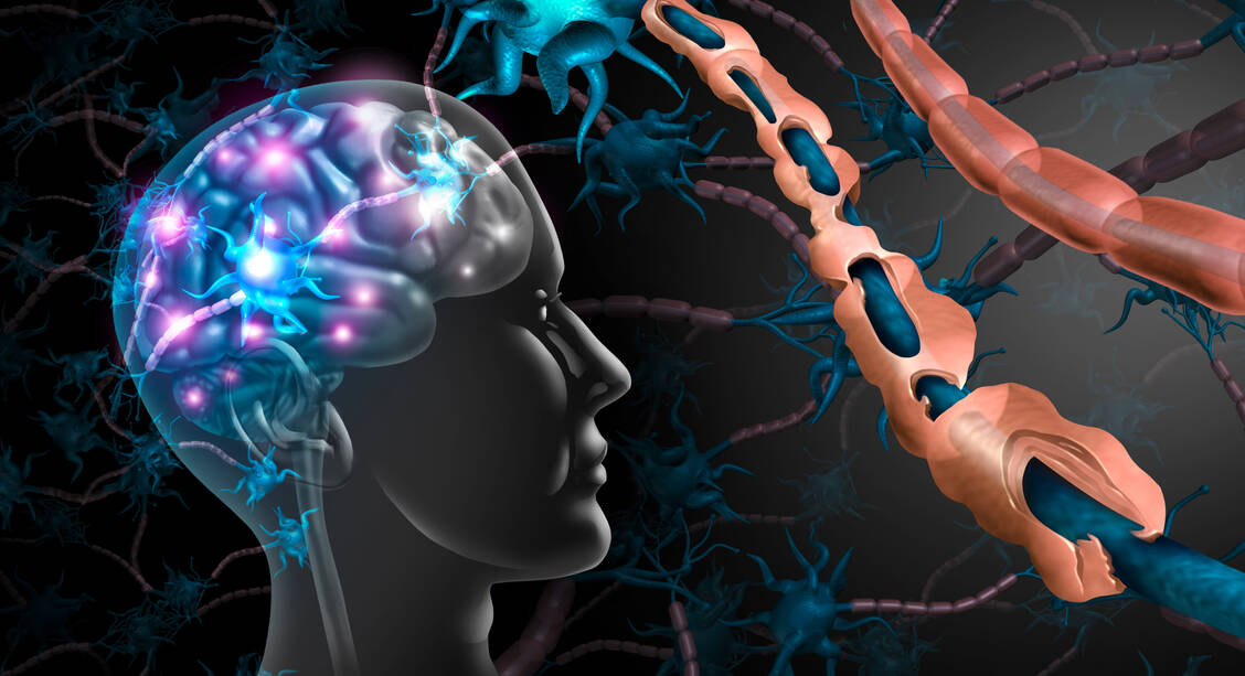 Bei Multipler Sklerose kommt es zu einem Abbau der isolierenden Myelinschicht am Axon. / Foto: Adobe Stock/freshidea