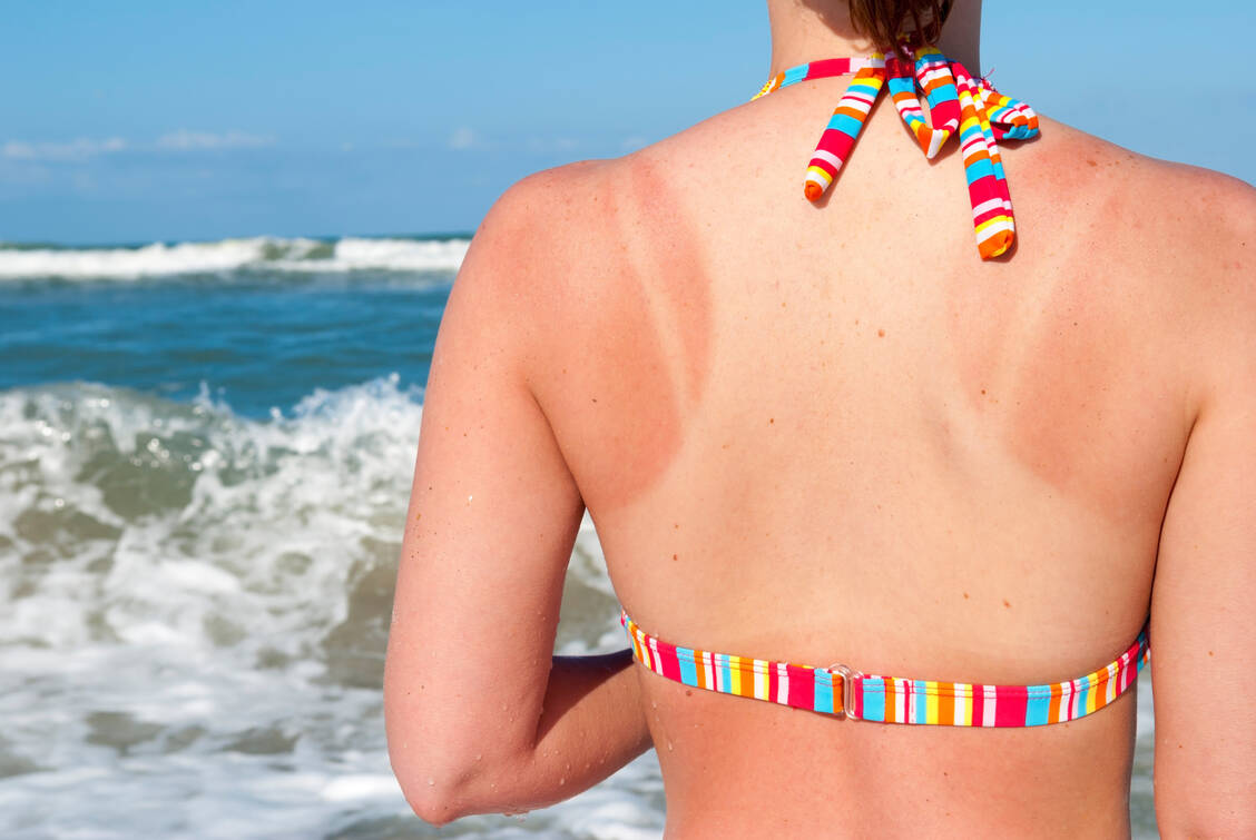 Die Haut vergisst nicht. Jeder Sonnenbrand erhöht das Risiko für Hautkrebs. / © Getty Images/Joel Carillet