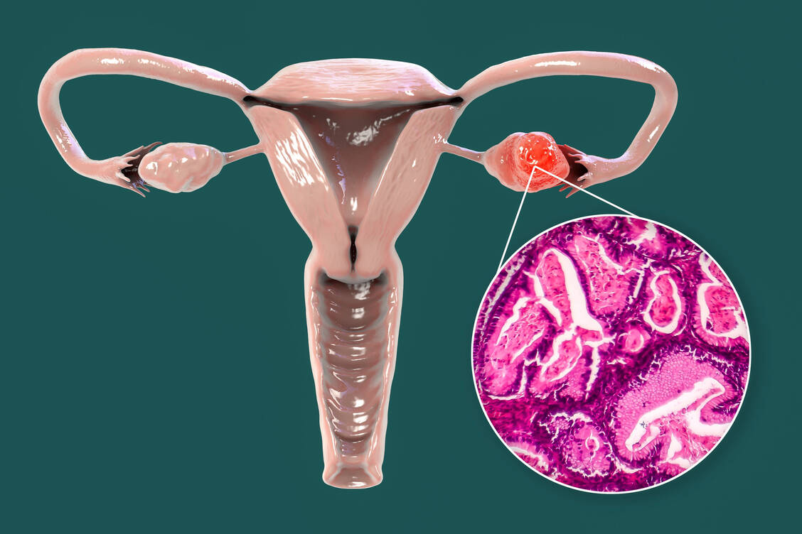 Eierstockkrebs ist die fünfthäufigste krebsbedingte Todesursache bei Frauen. / © Getty Images/Kateryna Kon/Science Photo Library
